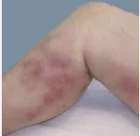 Diagnoza in zapleti krčnih žil