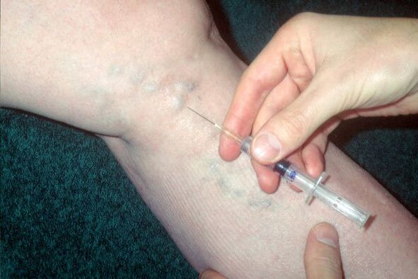 skleroterapija krčnih žil