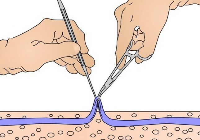 odstranjevanje ven za krčne žile