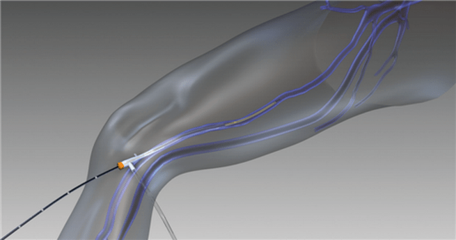 radiofrekvenčna obliteracija krčnih žil