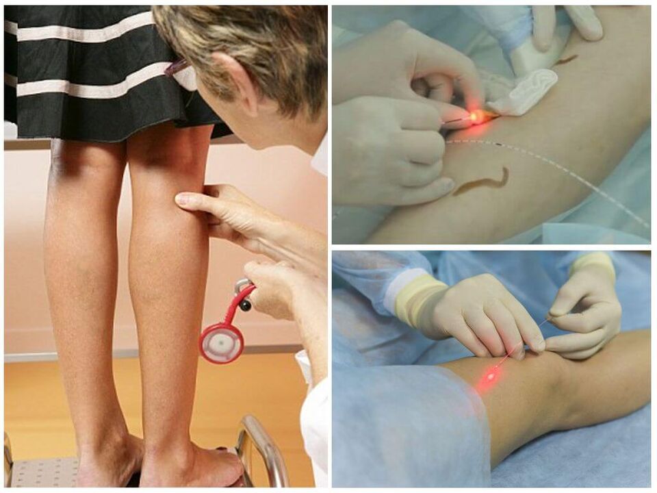 Potek postopka laserske koagulacije krčnih žil na nogah